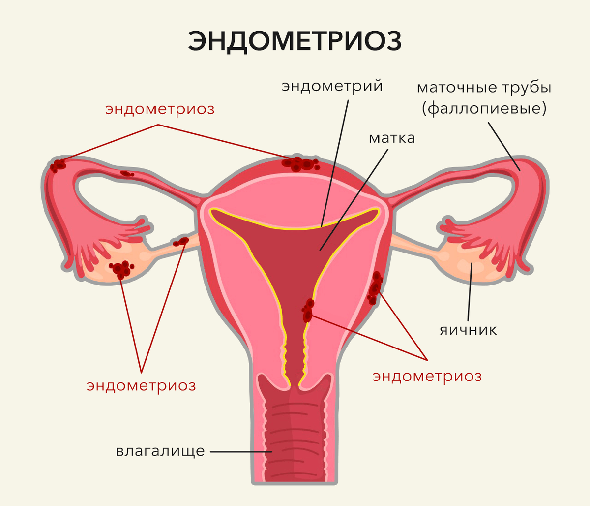 Каловый камень - причины, симптомы, диагностика, лечение, профилактика