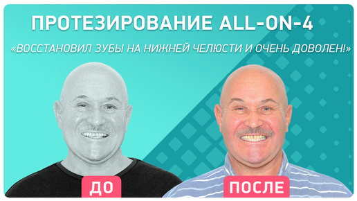 Протезирование All-on-4 на нижней челюсти. Отзыв пациента через 1 год. Технология Nobel Biocare