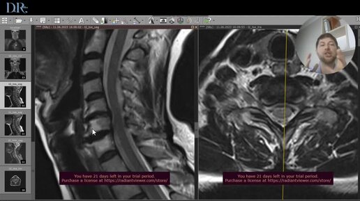 Как читать МРТ шейного отдела позвоночника - спондилодисцит . Разбор пациента с болью в шее // Доктор Денис Редько