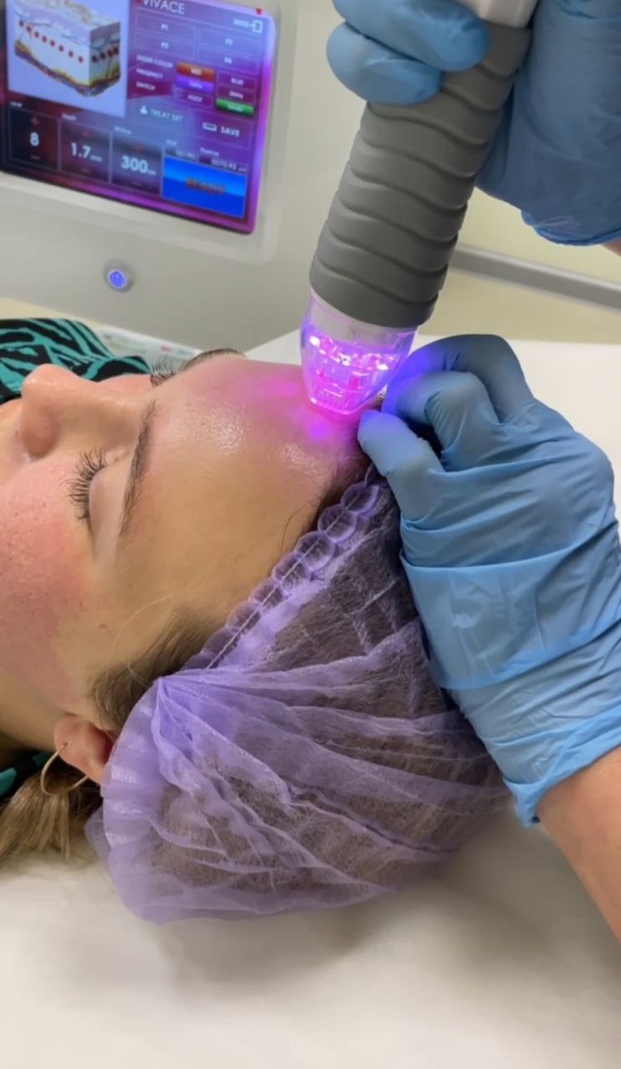 Процедура на аппарате VIVACE. Фото с приёма доктора Меньщиковой