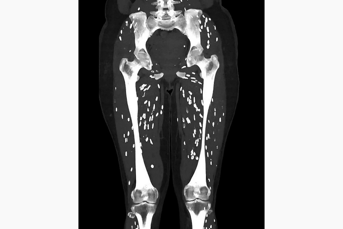 EM_RESUS / X📷Снимок с последствиями употребления полусырой свинины для организма человека