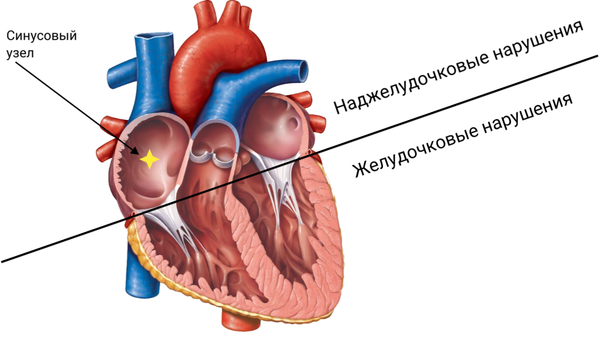Условная линия разделяющая наджелудочковые и желудочковые нарушения ритма по источнику