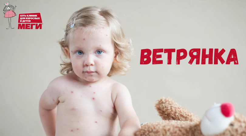 Что нужно знать о ветрянке