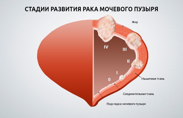 Удаление рака мочевого пузыря