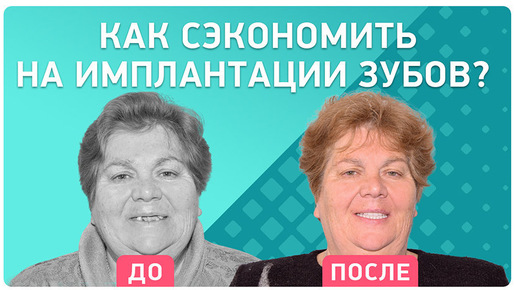 О протезировании all-on-4: как сэкономить безопасно на имплантации всех зубов?