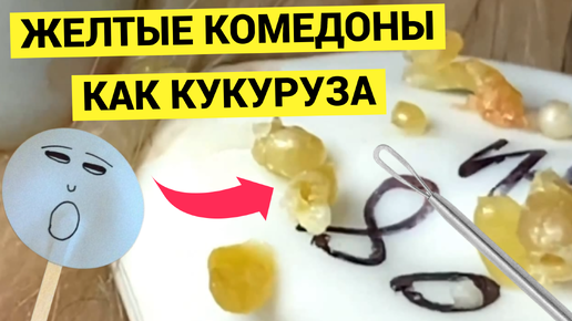 Желтые как КУКУРУЗА Комедоны и Жировики Пришлось Выдавливать Мастеру не без Труда. Зачем так тянула с визитом к Косметологу дама?