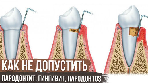 Video herunterladen: Пародонтит, Гингивит, Пародонтоз, Профилактика Заболевания Десен