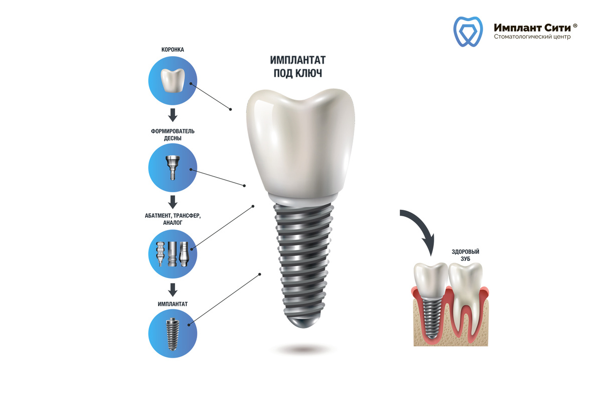 Все составляющие из которых состоит имплант под ключ.