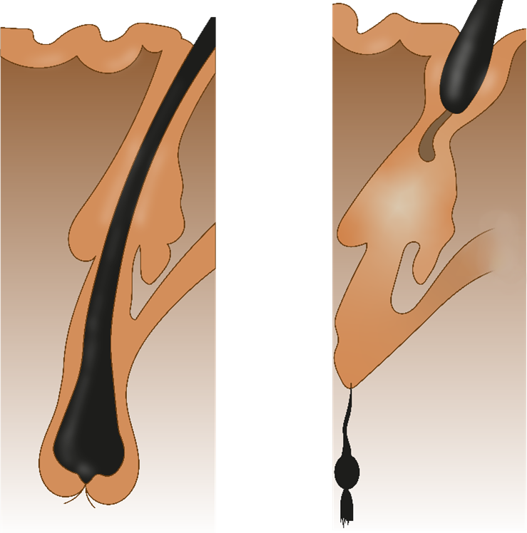 Волос слева плотно сидит в фолликуле и выпадать не собирается; волос справа отрезан от кровоснабжения и находится в процессе выпадения