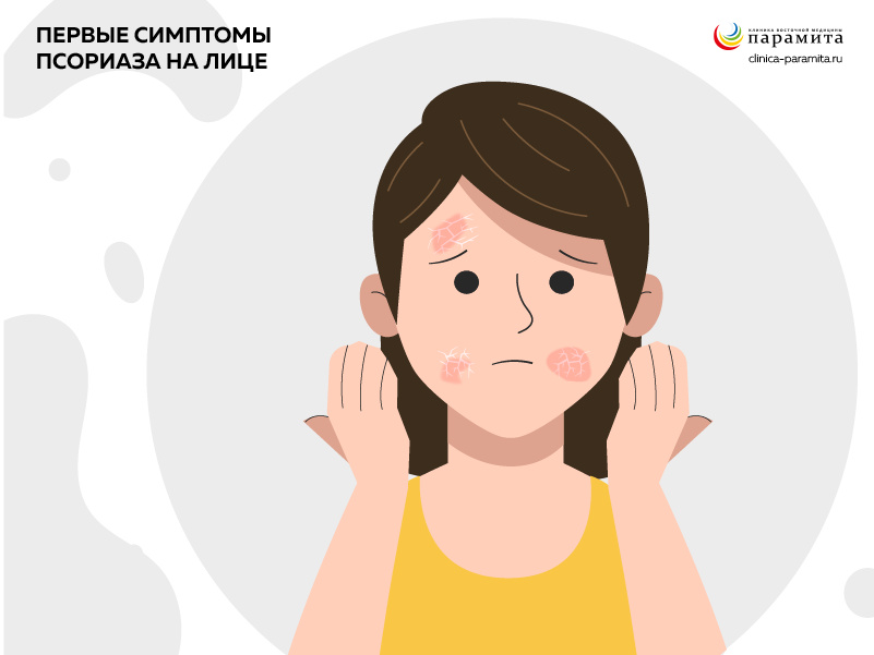 Псориаз на лице локализуется в области носогубного треугольника, век, над бровями, на заушных участках