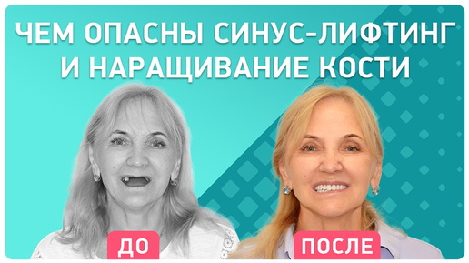 Опасные последствия синус-лифтинга и наращивания костной ткани 👉 Откровенный отзыв пациента-врача