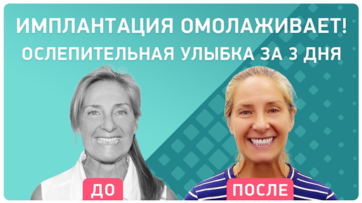 Результат комплексной имплантации за 3 дня – красивые, функциональные зубы и лицо без морщин!