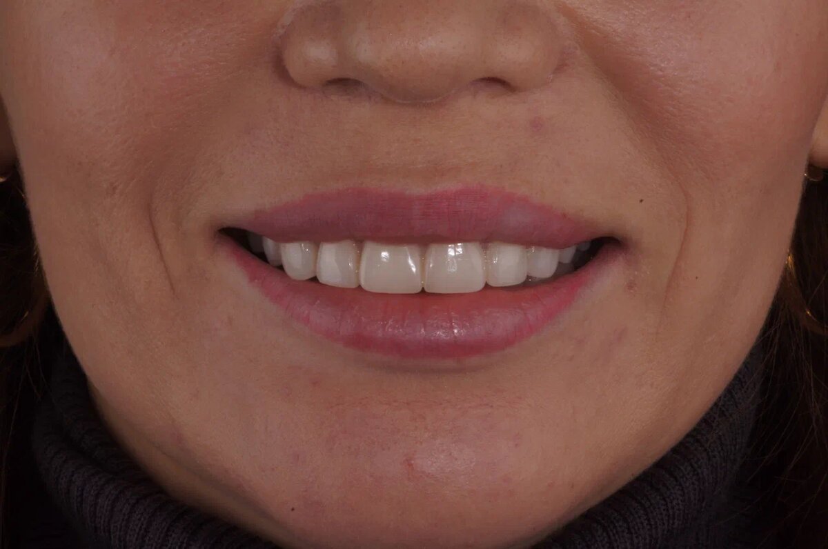 Пациентка NKclinic после установки виниров