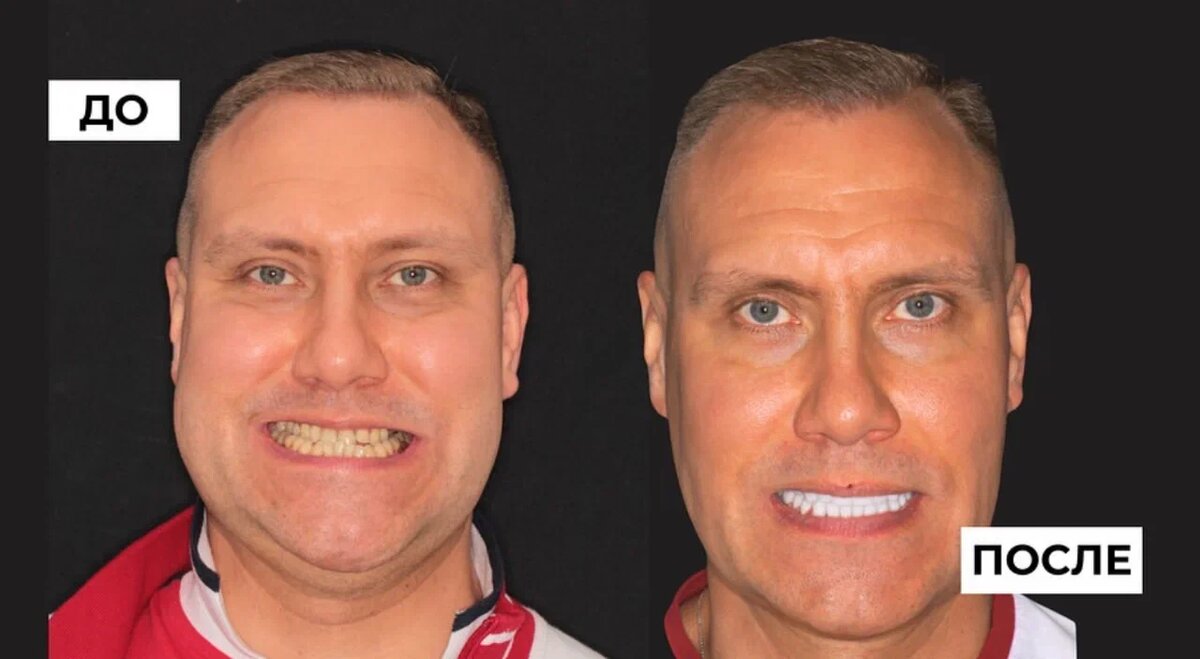 Пациент NKclinic до и после реставрации керамическими винирами