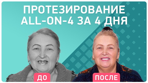 Протезирование и имплантация all-on-4 на оригинальных имплантах Nobel – отзыв пациента