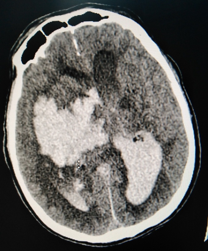 Крупные белые пятна это кровь в полости черепа. Следующий кард в галерее (листайте вправо - моча. Красная от крови.