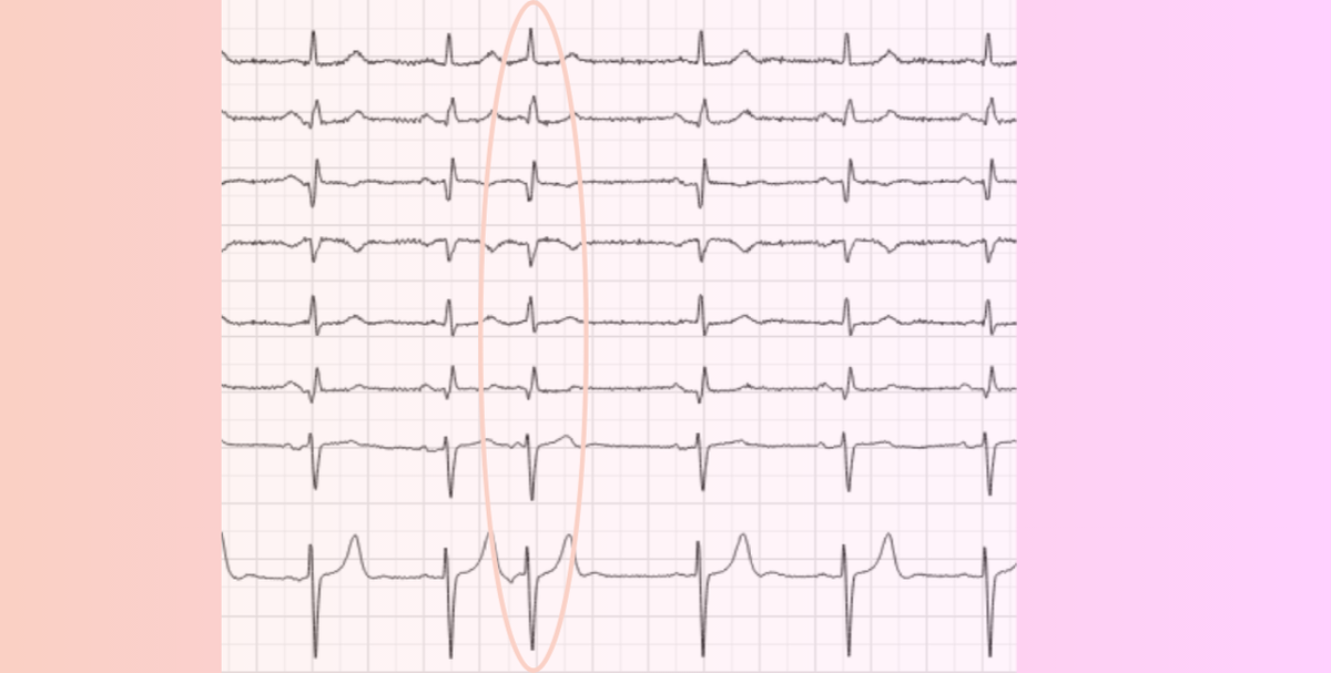 Одиночные наджелудочковые экстрасистолы
