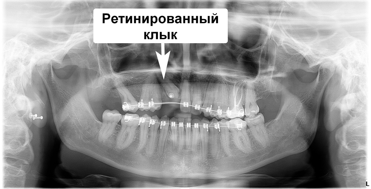 Клык не прорезался и находится в толще костной ткани верхней челюсти