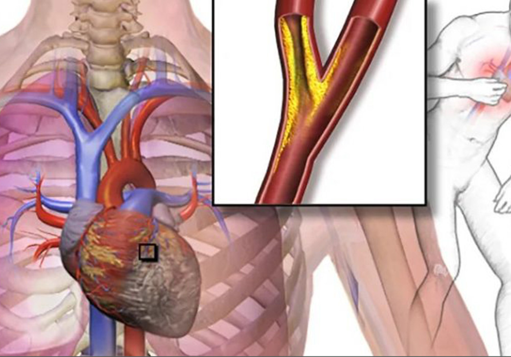 Ишемическая болезнь сердца (ИБС)