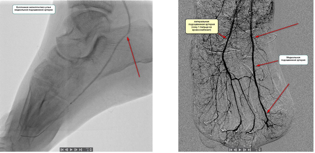 Баллонная ангиопластика артерий голени и стопы - медиальной подошвенной артерии (указана стрелками)