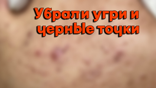 На перчатке насобирали уже целую кучу прыщей, и еще осталось полно работы