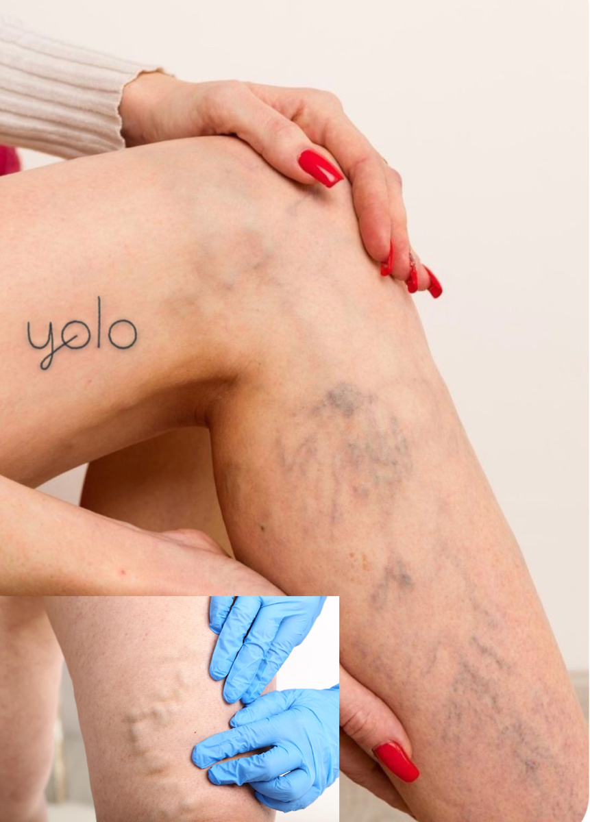 Варикоз- расширение вен.