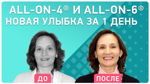 Можно ли вернуть все зубы сразу? Отзыв пациентки о новых технологиях в области протезирования