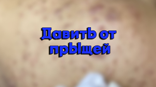 Прыщи с НОСА убираем после аккуратно кожу убираем