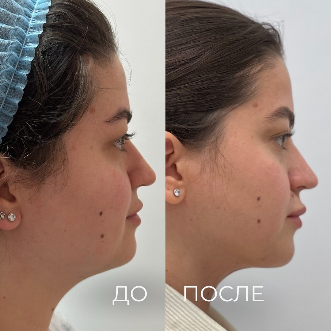 Коррекция нижней трети лица с помощью технологии FaceTite на платформе Inmode