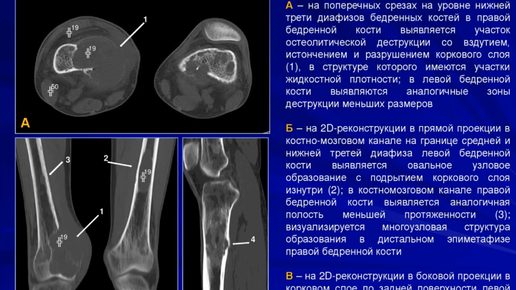 Клиническое наблюдение первичного гиперпаратиреоза