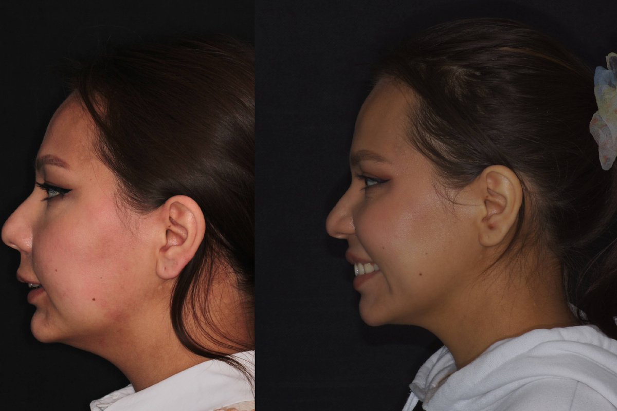 Фотопрокотокол пациентки до и после лечения в NKclinic