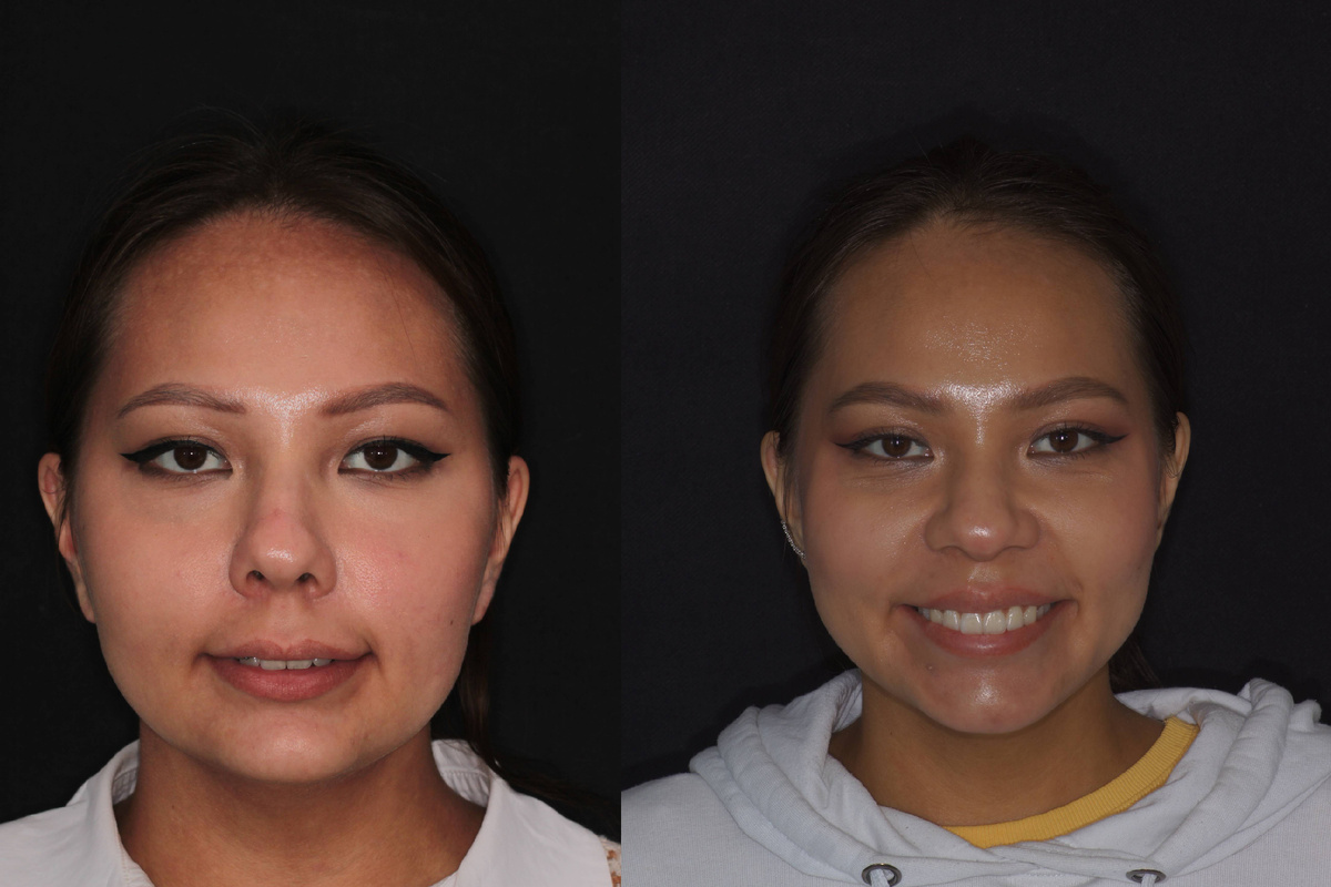 Фото пациентки А. до и после лечения в NKclinic (листайте)