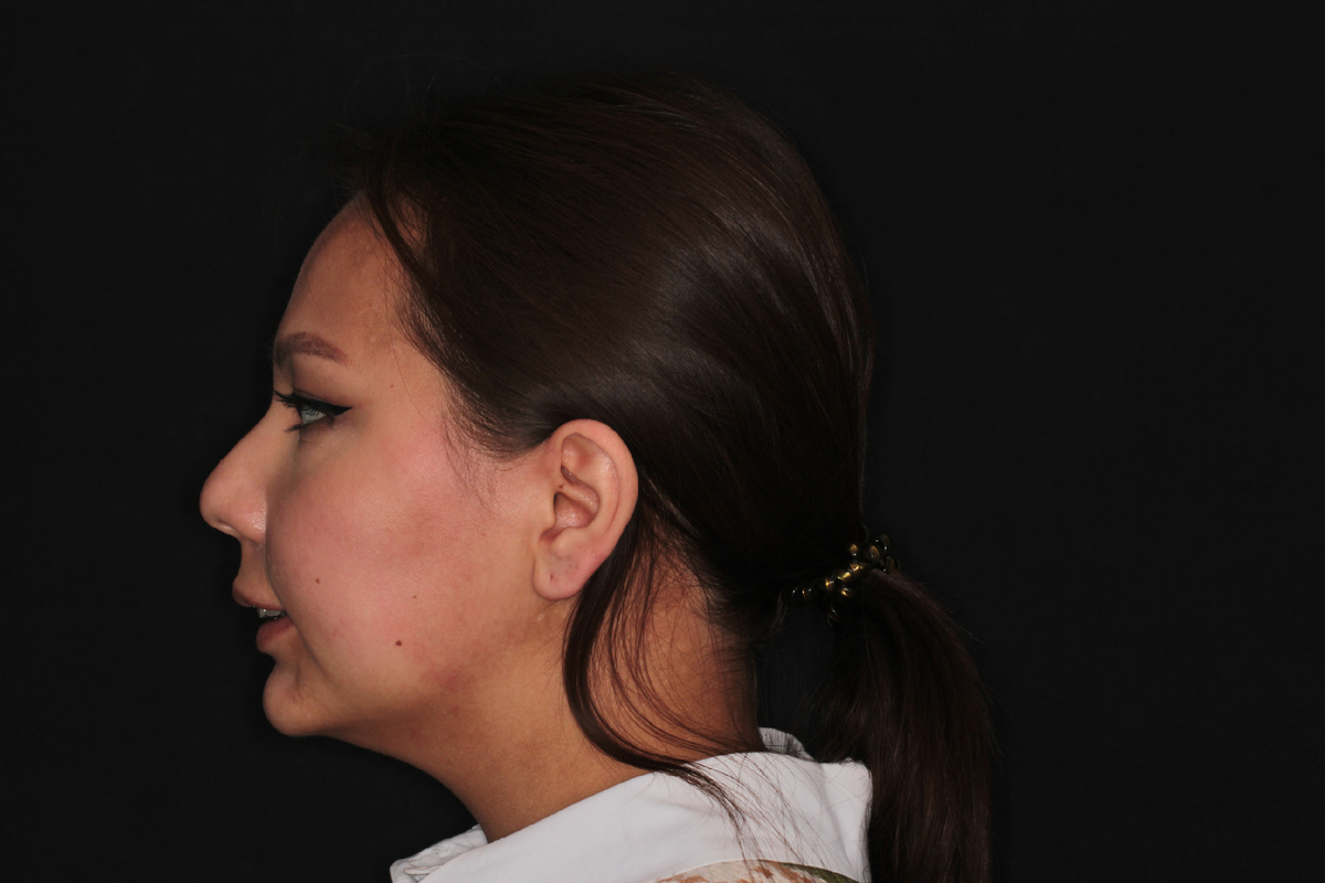 Пациентка А. до лечения в NKclinic. Фотопротокол. Публикуется с согласия пациентки