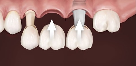 Мост с опорой на имплант и собственный зуб