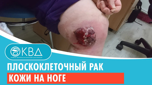 🦵 Плоскоклеточный рак кожи на ноге