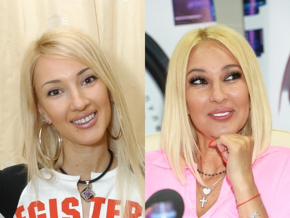    Лера Кудрявцева. Наращенные ресницы телеведущей не всегда выглядят аккуратно: они будто бы в комочках туши и в некоторых местах волоски выпали. Но есть и снимки Кудрявцевой без объемных ресниц, широких бровей и отбеленных зубов. Фото: legion-media.ru