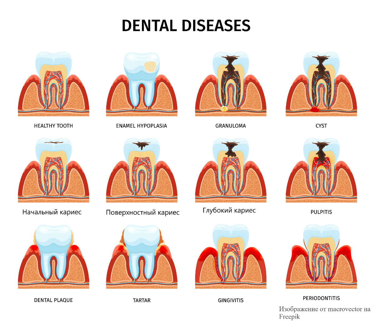 Обратите внимание на средний ряд. Нет изображения среднего кариеса, но вся разница между средним и глубоким кариесом заключается в глубине проникновения в дентин зуба (средний доходит до средних слоёв, а глубокий, соответственно, распространяется глубже, до околопульпарного слоя дентина). www.freepik.com