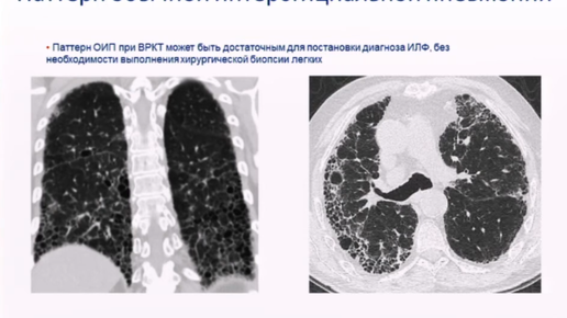 Дифференциальный диагноз интерстициальных заболеваний легких