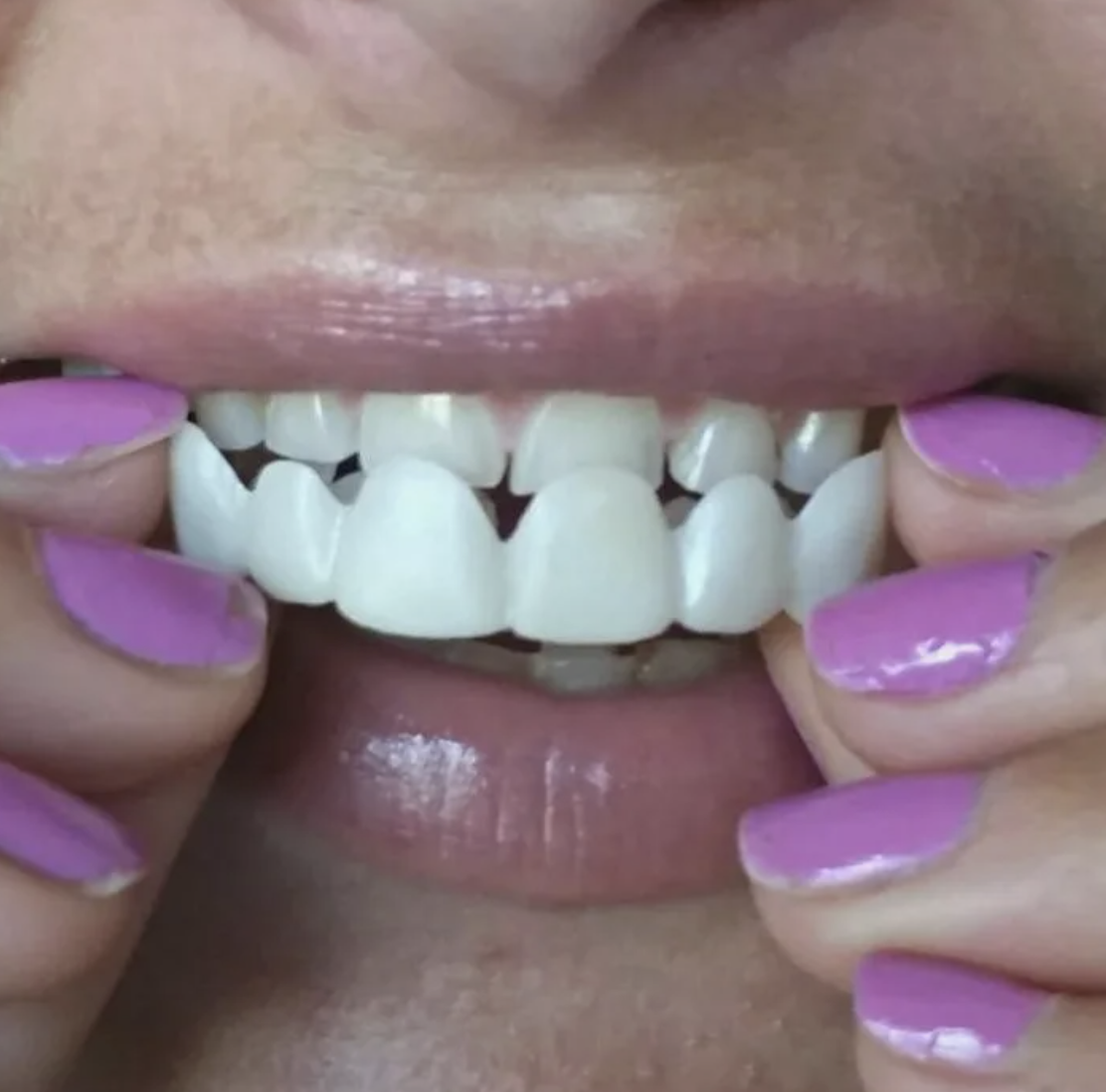 Виниры на зубы в ростове. Виниры комплект Snap-on smile. Cъемные виниры perfect smile Veneer (Snap on smile). Виниры TRUSMILE Veneers. True smile виниры.