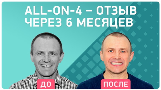 Имплантация ALL-ON-4® на имплантах Nobel – спустя 6 месяцев после лечения