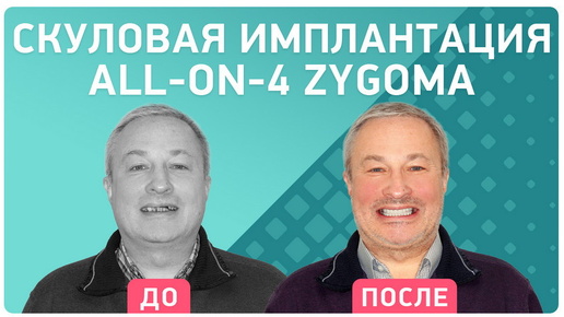 Скуловая имплантация Zygoma All-on-4® – отзыв пациента 56 лет