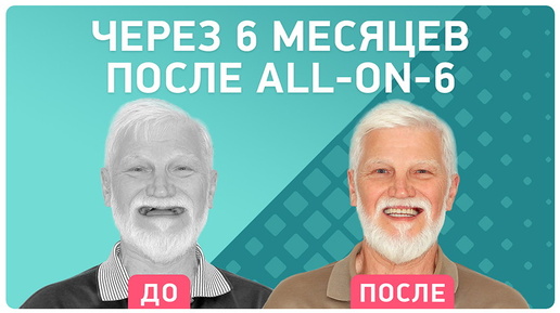 Имплантация ALL-ON-6 – отзыв пациента через 6 месяцев после установки имплантов