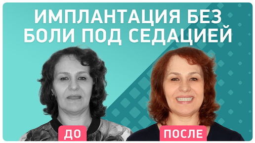 Полное восстановление зубов за пару дней 👉 отзыв спустя 6 месяцев после имплантации