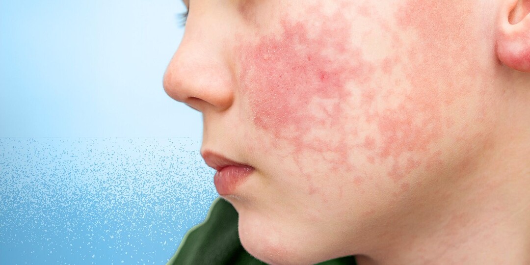 Вирус «пощечины» распространяется по миру