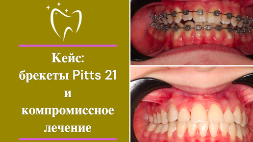 Кейс брекеты Pitts 21 и компромиссное лечение