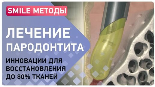 Как вылечить пародонтит? Инновационные решения!