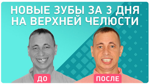 Имплантация верхних зубов за 3 дня: отзыв пациента клиники Smile-at-Once