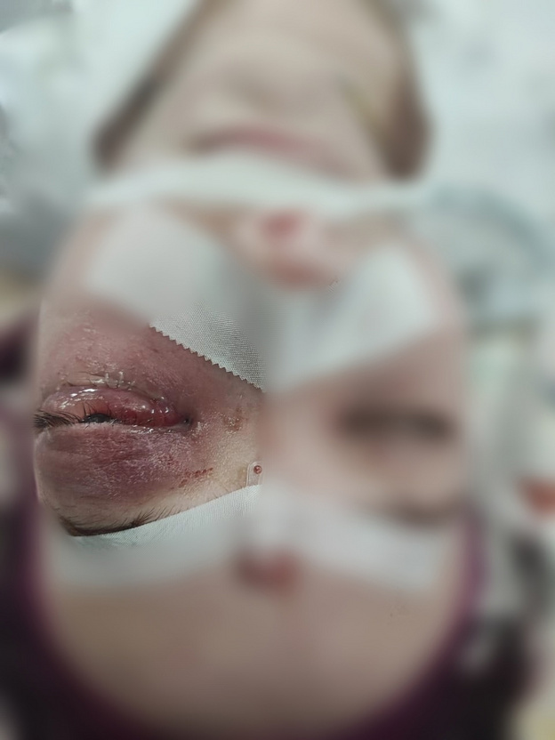    Кировские врачи спасли зрение 16-летней пациентке