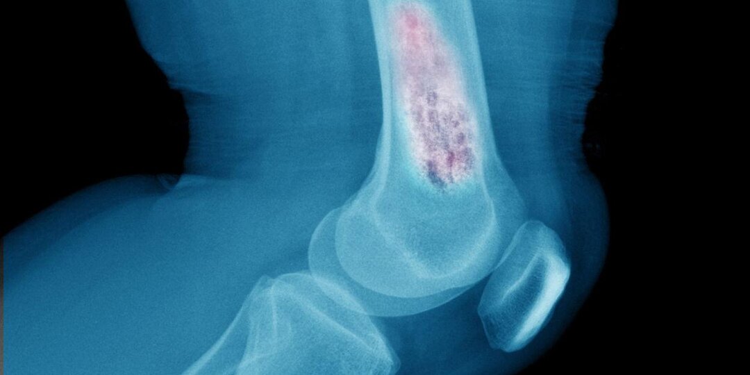 Рак костей — кто в группе риска?
