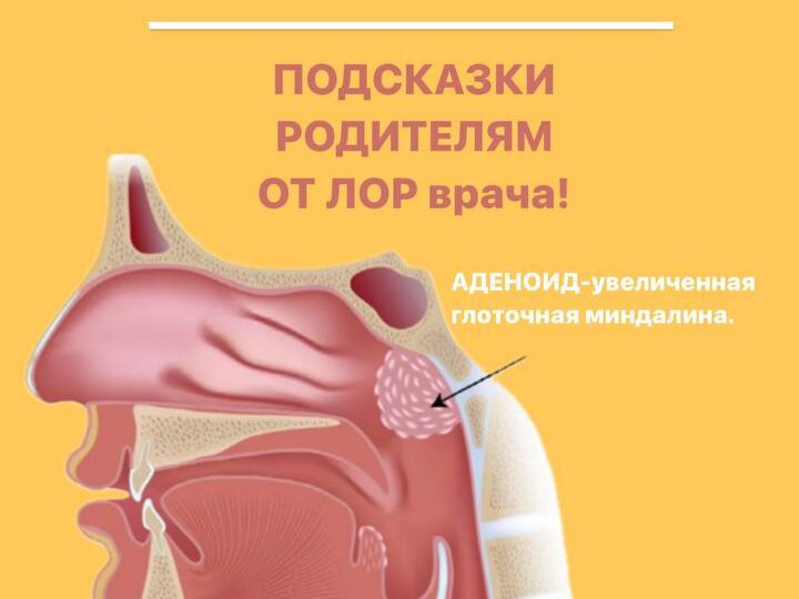 АДЕНОИДЫ у детей! Подсказки родителям от ЛОР врача!